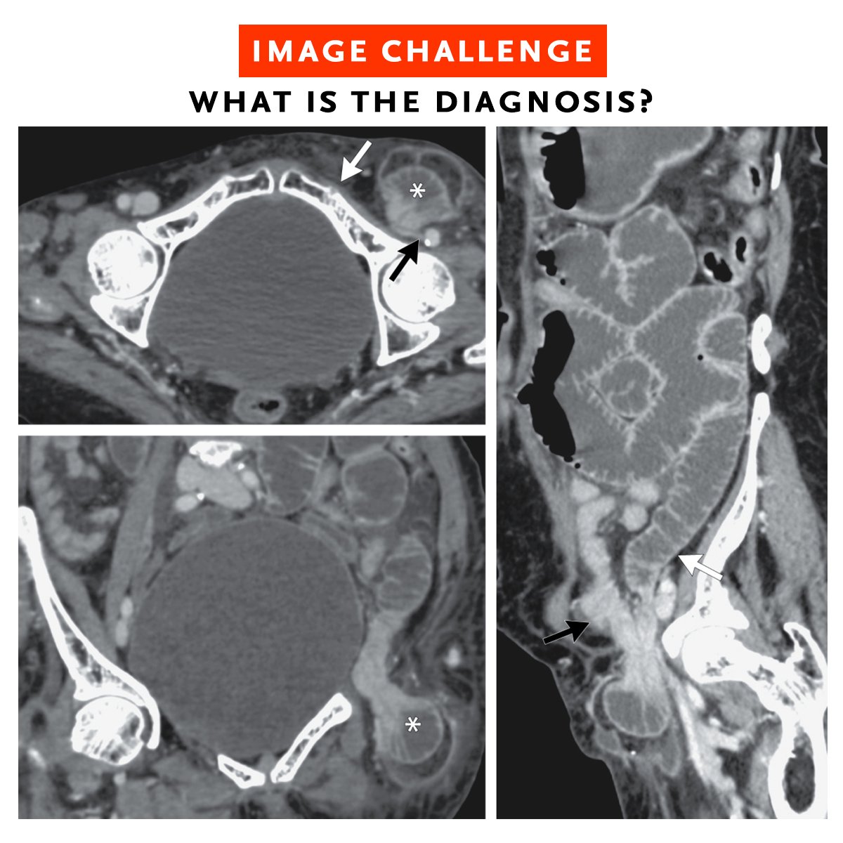 A 77-year-old woman presented to the emergency department with a 2-day history of abdominal pain, nausea, and vomiting. On physical examination, there was abdominal distension with tenderness in the left lower quadrant. Read the full case details and submit your answer or see how