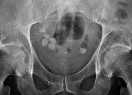 ABDOMINAL X-RAY 3: What is the abnormality seen in this close-up image of the pelvis? Answer bit.ly/40zci7X