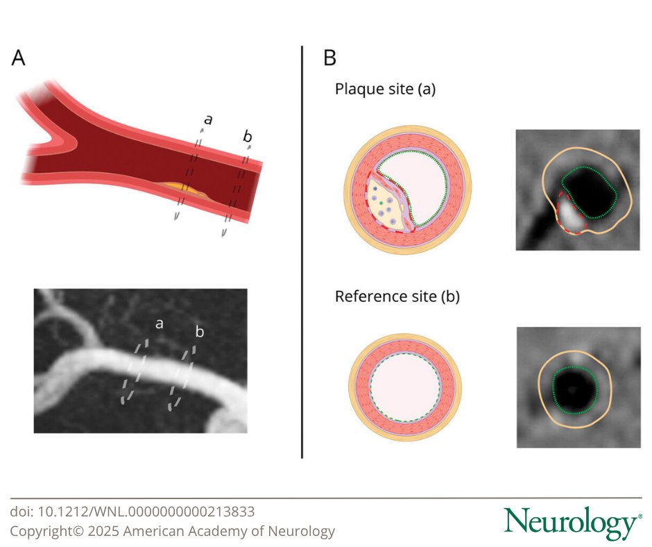 Intracranial Nonstenosing Atherosclerotic Plaques Assessed With Vessel Wall MRI in Patients With Embolic Stroke of Undetermined Source
hubs.la/Q03vSMRJ0