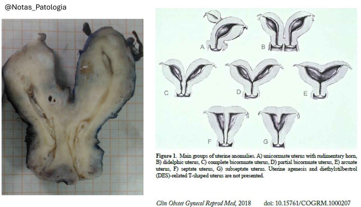 🔬 Müllerian Duct Anomalies: Focus on Complete Bicornuate Uterus

Congenital uterine anomalies result from defects in the formation, fusion, or resorption of the Müllerian ducts during embryogenesis. These anomalies are often associated with urinary tract malformations due to the