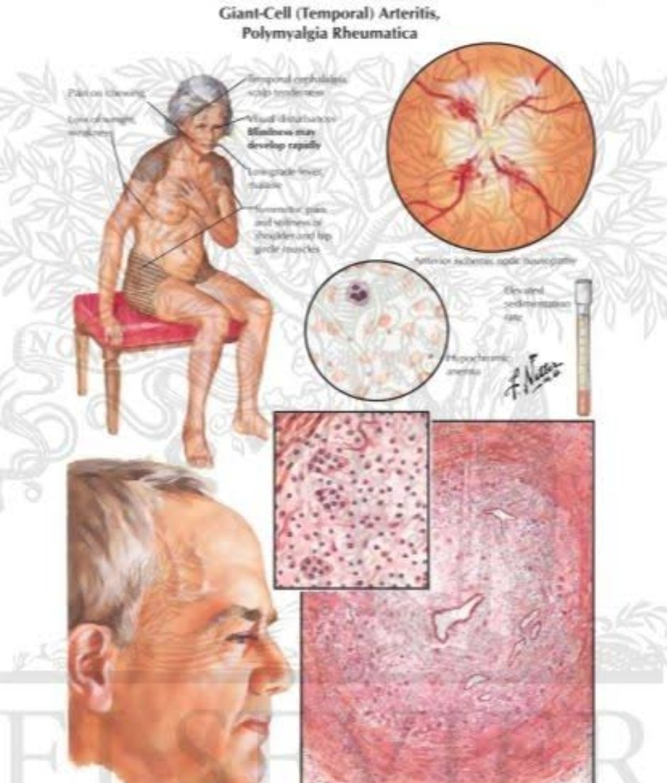Dr_AndreRibeiro's tweet image. 🔬 Despite promising Phase 2 data, the Phase 3 #GCAptAIN trial of #Cosentyx in giant cell arteritis failed to meet its primary endpoint.
📉 Sustained remission at Week 52 not achieved.

A critical reminder: Phase 3 matters.
Rigorous validation is key in #Rheumatology.