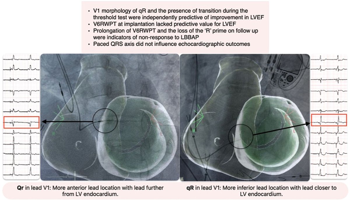 Paced qR morphology and transition during threshold testing predicted greater improvement in LVEF, whereas RWPT lacked predictive value. Loss of terminal R in lead V1 and prolongation of RWPT on follow-up prognosticated nonresponse to LBBAP.
heartrhythmjournal.com/article/S1547-…