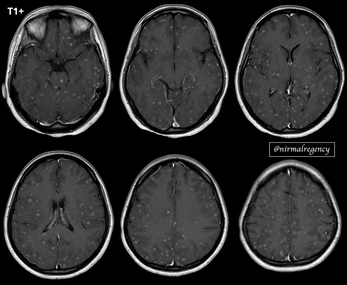 ✨Sunday is back 💫
Today we will talk about a common CNS infection in our part of the world w/ rare views

32♀

Miliary CNS tuberculomas
Like a starry night 🌌

Pre Rx – MR contrast 👇
#neurotwitter #NeuroX #MedTwitter #MedX #Neurology #FOAMmed #CNS #Tuberculosis 
short 🧵 
1/7