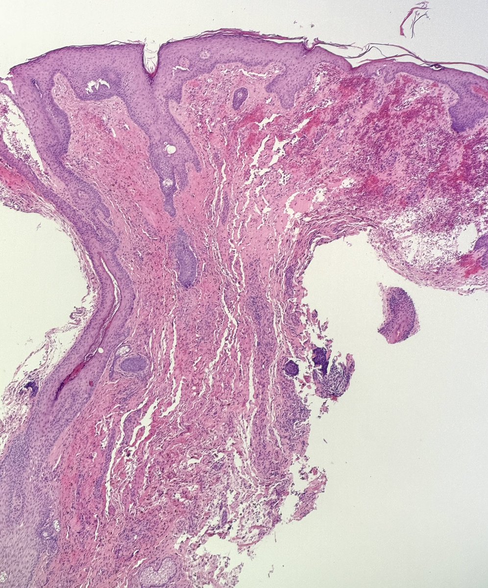 MBBS_Pathology's tweet image. #CutaneousAngiosarcoma
Location = scalp
Irregular, jagged, infiltrative, thin-walled vessels leaking red cells, with Fe released from Hb being devoured by macrophages (haemosiderin). Atypical pleomorphic & hyperchromatic endothelial cells.
#nasty
#pathology
#dermatology