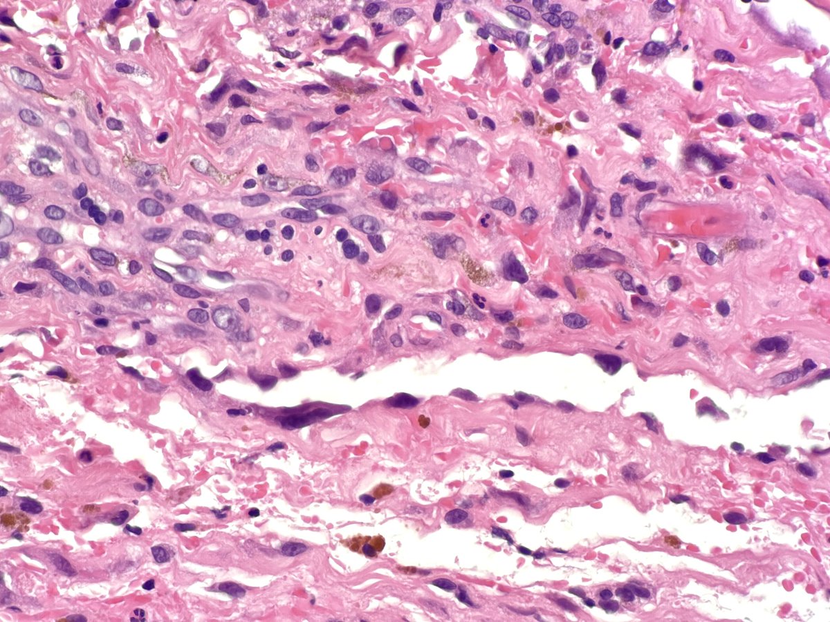 MBBS_Pathology's tweet image. #CutaneousAngiosarcoma
Location = scalp
Irregular, jagged, infiltrative, thin-walled vessels leaking red cells, with Fe released from Hb being devoured by macrophages (haemosiderin). Atypical pleomorphic & hyperchromatic endothelial cells.
#nasty
#pathology
#dermatology