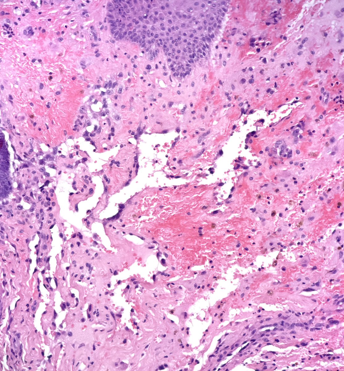 MBBS_Pathology's tweet image. #CutaneousAngiosarcoma
Location = scalp
Irregular, jagged, infiltrative, thin-walled vessels leaking red cells, with Fe released from Hb being devoured by macrophages (haemosiderin). Atypical pleomorphic & hyperchromatic endothelial cells.
#nasty
#pathology
#dermatology