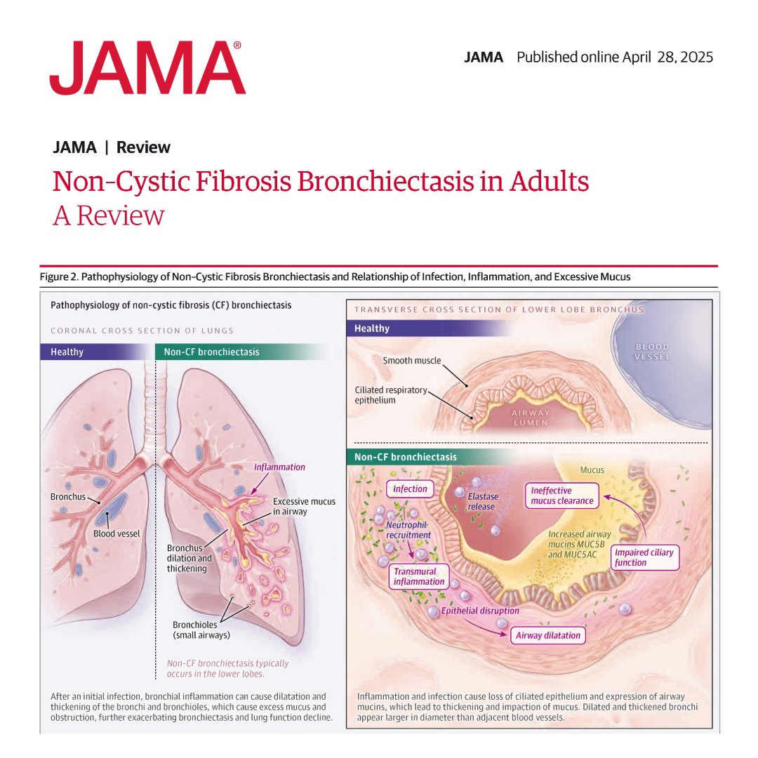 Non-cystic fibrosis (CF) bronchiectasis is a chronic lung condition that typically causes cough and sputum production, and exacerbations are associated with progressive decline in lung function and decreased QOL. 

Read this Review to learn more about non–CF bronchiectasis.
