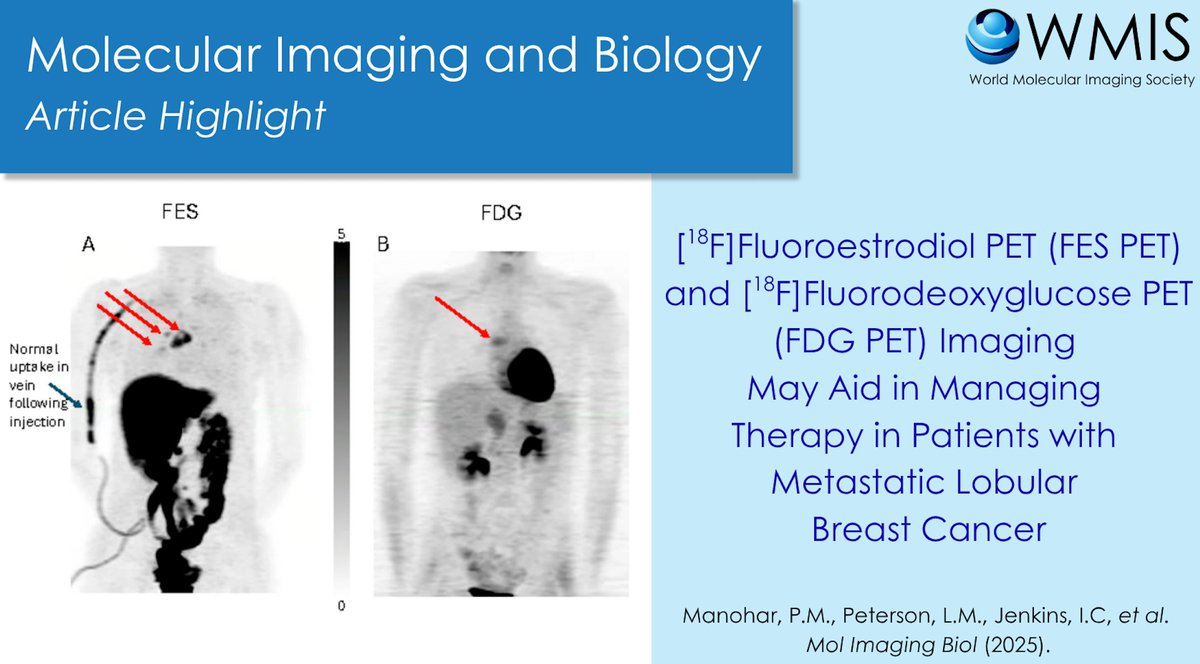 WMIS WMIC (@wmiswmic) on Twitter photo #MIBArticleHighlight Infiltrating lobular cancer comprises 5-15% of breast cancers and differs from the more common ductal histology. Manohar et al. have used FES- and FDG-PET to aid in selecting ILC patients for breast cancer therapy.
Read here! rdcu.be/etzR1 #MIBArticleHighlight Infiltrating lobular cancer comprises 5-15% of breast cancers and differs from the more common ductal histology. Manohar et al. have used FES- and FDG-PET to aid in selecting ILC patients for breast cancer therapy.
Read here! rdcu.be/etzR1