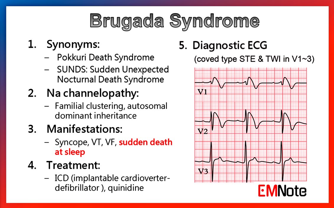 Brugada Syndrome