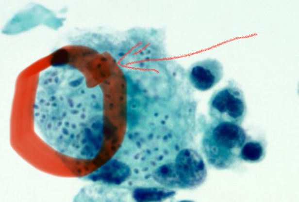 Sanjay Mukhopadhyay (@smlungpathguy) on Twitter photo <a href="/Path4People/">Jay "Thymocyte" Hwang</a> <a href="/Baskotacytopath/">Swikrity U Baskota,MD, FCAP</a> <a href="/SansanoValero/">Irene Sansano, MD Phd</a> <a href="/AmparoBenito/">Amparo Benito Berlinches</a> <a href="/mezeitibi/">Tibor Mezei</a> <a href="/raghupillappa/">Raghavendra Pillappa</a> <a href="/MdSuster/">DavidSusterMD</a> <a href="/parthisandy/">Sandhya Ramachandran</a> <a href="/kis_lorand/">Lorand Kis</a> <a href="/DrAhmedKalebi/">𝗗𝗿 𝗔𝗵𝗺𝗲𝗱 𝗞𝗮𝗹𝗲𝗯𝗶, 𝕆𝔾𝕎</a> <a href="/AyeshaSAzam/">Dr Ayesha Azam, FRCPath</a> <a href="/DrGeeONE/">Olaleke Folaranmi</a> <a href="/pembeoltulu/">Pembe Oltulu, MD</a> <a href="/JMGardnerMD/">Jerad Gardner, MD</a> <a href="/kalishahillmd/">Kalisha Hill, MD, MBA for CAP President-Elect 2025</a> <a href="/IHC_guy/">Andrew Bellizzi 🇺🇦</a> <a href="/Williamson_SR/">Sean R Williamson MD</a> <a href="/VijayPatho/">Vijay Shankar S</a> <a href="/whosainastro/">Muhammad Hussain, MD</a> 51. PGY1s, you will learn about special stains that help to pick out microorganisms (AFB, GMS, PAS). But remember that many bugs are also visible on routine stains such as H&E and pap (used in cytology, shown here). Arrow: Histoplasma yeasts (dots) within a large histiocyte <a href="/Path4People/">Jay "Thymocyte" Hwang</a> <a href="/Baskotacytopath/">Swikrity U Baskota,MD, FCAP</a> <a href="/SansanoValero/">Irene Sansano, MD Phd</a> <a href="/AmparoBenito/">Amparo Benito Berlinches</a> <a href="/mezeitibi/">Tibor Mezei</a> <a href="/raghupillappa/">Raghavendra Pillappa</a> <a href="/MdSuster/">DavidSusterMD</a> <a href="/parthisandy/">Sandhya Ramachandran</a> <a href="/kis_lorand/">Lorand Kis</a> <a href="/DrAhmedKalebi/">𝗗𝗿 𝗔𝗵𝗺𝗲𝗱 𝗞𝗮𝗹𝗲𝗯𝗶, 𝕆𝔾𝕎</a> <a href="/AyeshaSAzam/">Dr Ayesha Azam, FRCPath</a> <a href="/DrGeeONE/">Olaleke Folaranmi</a> <a href="/pembeoltulu/">Pembe Oltulu, MD</a> <a href="/JMGardnerMD/">Jerad Gardner, MD</a> <a href="/kalishahillmd/">Kalisha Hill, MD, MBA for CAP President-Elect 2025</a> <a href="/IHC_guy/">Andrew Bellizzi 🇺🇦</a> <a href="/Williamson_SR/">Sean R Williamson MD</a> <a href="/VijayPatho/">Vijay Shankar S</a> <a href="/whosainastro/">Muhammad Hussain, MD</a> 51. PGY1s, you will learn about special stains that help to pick out microorganisms (AFB, GMS, PAS). But remember that many bugs are also visible on routine stains such as H&E and pap (used in cytology, shown here). Arrow: Histoplasma yeasts (dots) within a large histiocyte