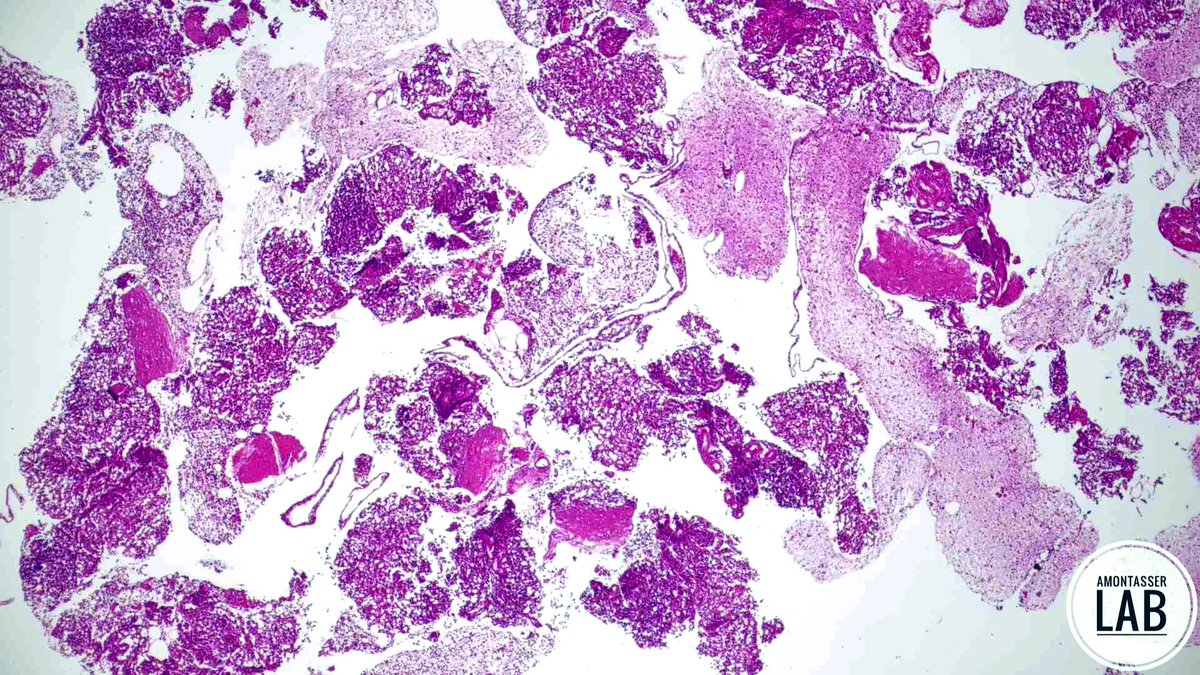AMontasserMD's tweet image. 9 Y 👦🏻
An “impressive” cellblock from a 6mm pancreatic tail nodule 🤓
Thoughts 💭 ❓
#GIpath #Pathology #PathX #Cytology #B9