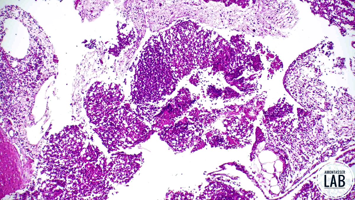 AMontasserMD's tweet image. 9 Y 👦🏻
An “impressive” cellblock from a 6mm pancreatic tail nodule 🤓
Thoughts 💭 ❓
#GIpath #Pathology #PathX #Cytology #B9