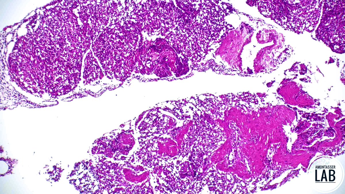 AMontasserMD's tweet image. 9 Y 👦🏻
An “impressive” cellblock from a 6mm pancreatic tail nodule 🤓
Thoughts 💭 ❓
#GIpath #Pathology #PathX #Cytology #B9