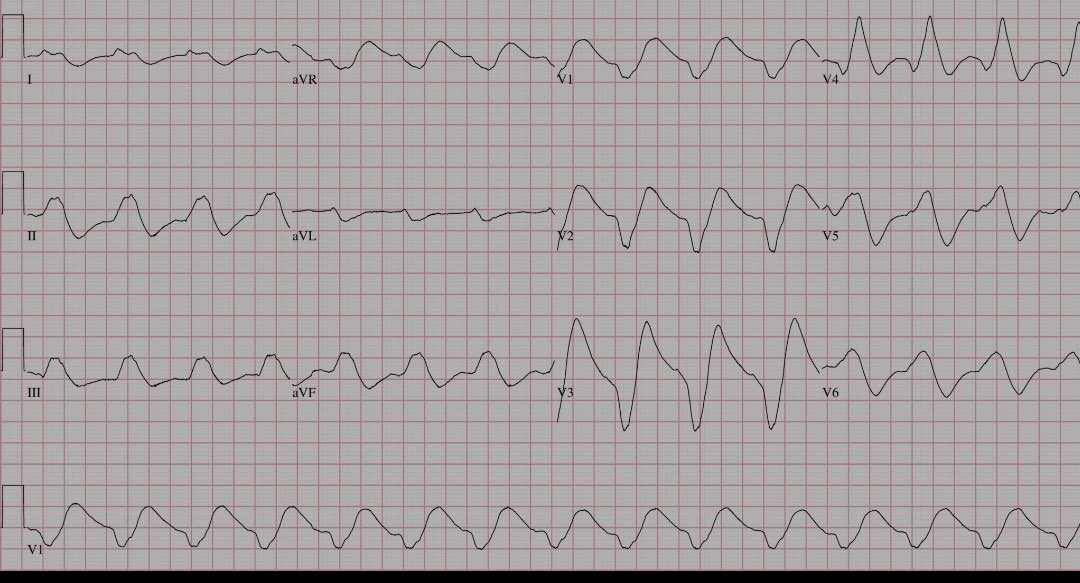 37 year old male after resuscitation from cardiac arrest

  Ecg  attached 
what is ur Ddx &amp; Rx?
