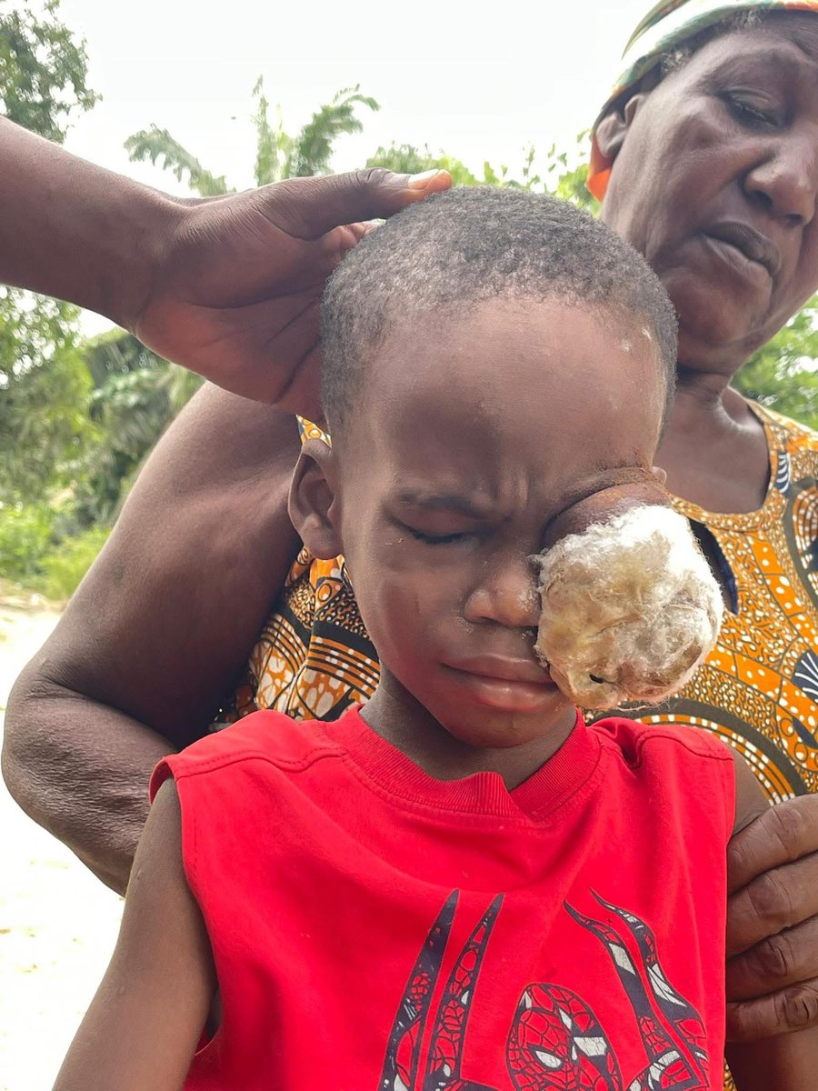 BaseAfricaTV_Gh's tweet photo. We are seeking Support for 5 years Old Robert who is going through so much pains and needs about GHc100,000 to undergo Surgery. 
No amount is too small to support. 
054 016 9707
020 207 2024
Clinton Yeboah 
Or Dial *713*034#
https://t.co/9ilV1fBLQ9
Paypal: Trendinghana@gmail.com https://t.co/yBmL150dgg