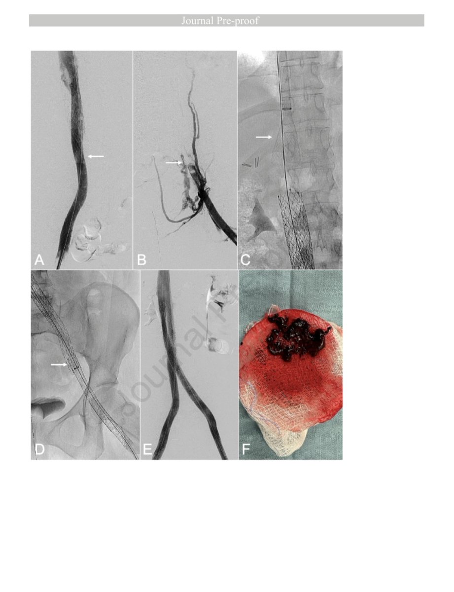 CHICKVIR's tweet image. Use of the Protrieve Sheath during large-bore venous thrombectomy resulted in favorable technical and clinical outcomes without adverse events or clinically significant thromboembolic events.
sciencedirect.com/science/articl…
@avsgjournal @CVIR_Journal @cvirendo @JVIRmedia @InariMedical