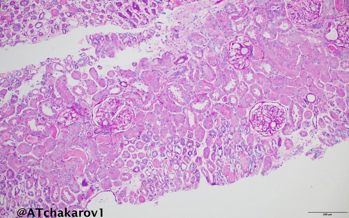 ATchakarov1's tweet image. Nice case of tubular epithelial injury in ATN. 👀🔬🫘 #RenalPath #Nephropath #PathX