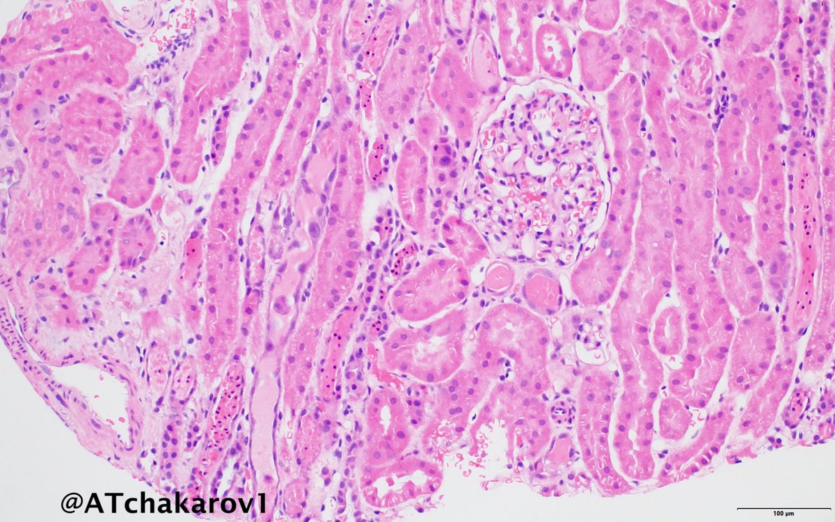 ATchakarov1's tweet image. Nice case of tubular epithelial injury in ATN. 👀🔬🫘 #RenalPath #Nephropath #PathX