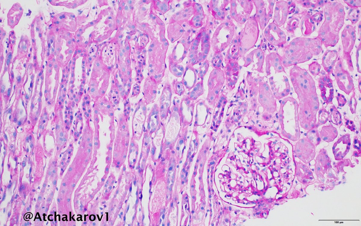 ATchakarov1's tweet image. Nice case of tubular epithelial injury in ATN. 👀🔬🫘 #RenalPath #Nephropath #PathX