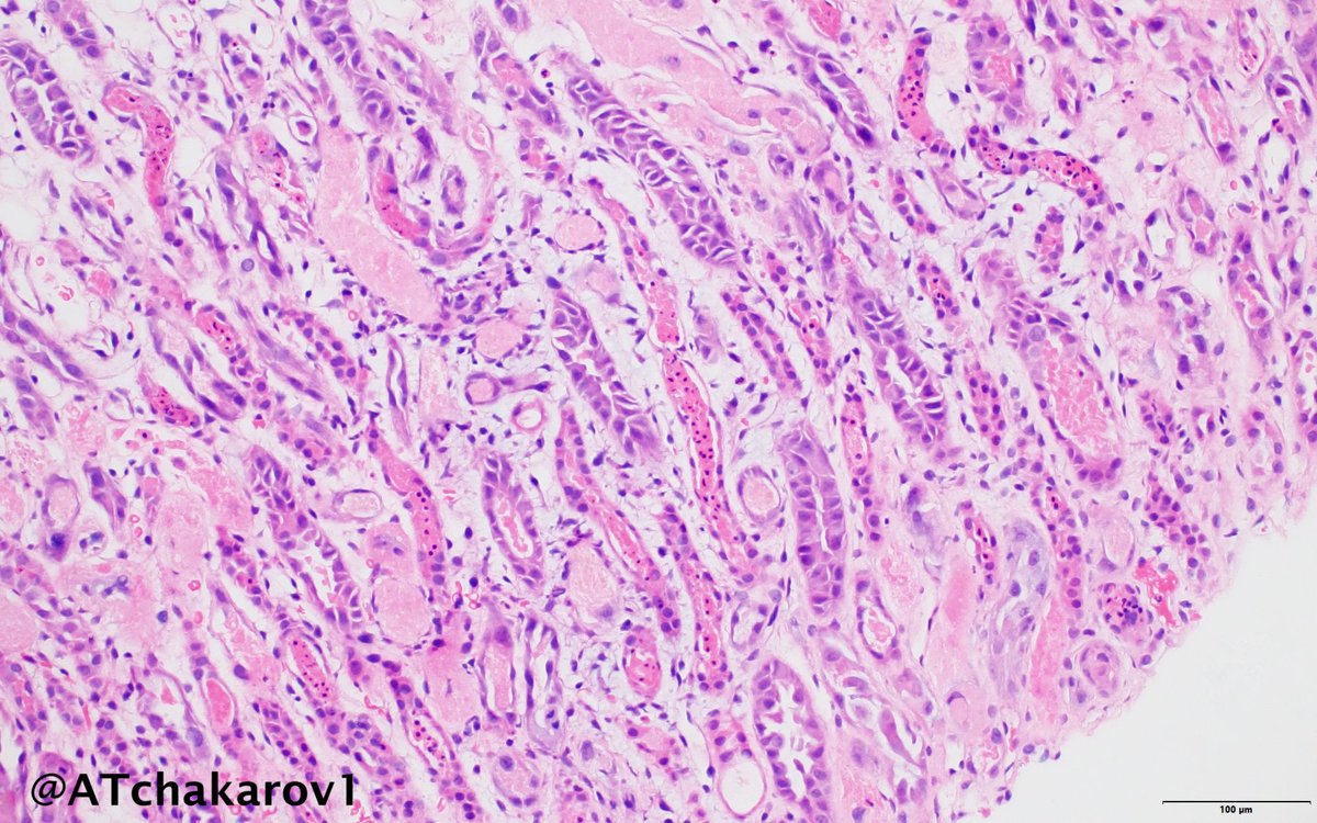 Nice case of tubular epithelial injury in ATN. 👀🔬🫘 #RenalPath #Nephropath #PathX