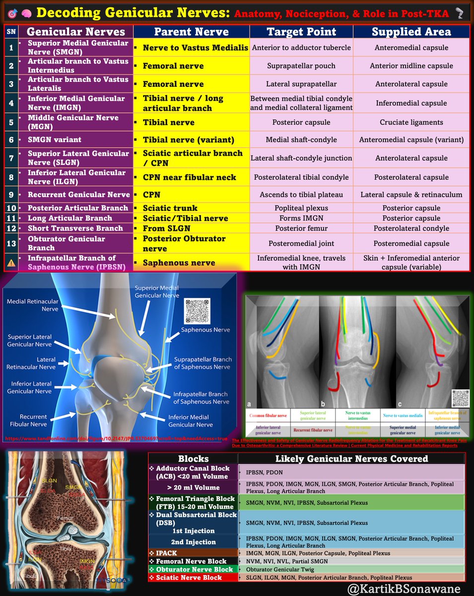 KartikBSonawane's tweet photo. 🎯🧠Decoding Genicular Nerves: Anatomy, Nociception, & Their Role in Knee Pain After TKA🦿
#GenicularNerves #KneeAnatomy #PostTKAPain
#NeuropathicPain #RegionalAnesthesia #PainMechanisms #TargetedBlocks #UltrasoundGuidedBlocks #AnatomyDecoded
#ClinicalAnatomy #Neuroanatomy #PainAfterTKA
#AnatomyMatters #TipOfTheDay #MyRATips
Tip of the Day:
1. 🔍 What Does "Genicular" Mean?
♦The term “genicular” comes from the Latin "genu", meaning knee.
♦These nerves supply the area around the knee, particularly its capsular, ligamentous, & periarticular structures.
♦Also influences vascular control and pain transmission.
♦Approximately 14 genicular nerves (mixed sensory/motor/autonomic) from 5 major nerves (FN, OBN, SCN, TN, CPN).
♦They follow a predictable course, often accompanying genicular arteries.
♦Essential target in modern-day pain management strategies, such as genicular nerve blocks (GNB) and radiofrequency ablation (RFA).
2. ❓ Is the Infrapatellar Branch a Genicular Nerve?
🚫 No, the IPBSN is not classified as a genicular nerve.
🔹Primarily a cutaneous nerve, but may contribute to the inferomedial anterior capsule, alongside the IMGN.
🔹Not traveling with genicular arteries or through periosteum.
🔹Responsible for selective anterior knee pain syndromes.
🔹Usually not targeted in GNB/RFA unless for cutaneous neuroma or peripatellar pain
3. 🎯 Genicular vs Articular Branches
⚡Genicular Nerves:
📍 Location: Periarticular soft tissues (around bones, ligaments)
🎯 Function: Involved in pain transmission, proprioception, & autonomic vascular tone
🔥 Nociceptor Density: High density – major contributors to persistent pain
🧠 Clinical Targetability: Precisely located & often ultrasound-visible for blocks or RFA
🦵 Role Post-TKA: Remain active and relevant even after joint replacement
🧩 Articular Branches:
📍 Location: Confined to joint capsule & synovial lining
🎯 Function: Transmit pain only; minimal role in proprioception or autonomic function
🔥 Nociceptor Density: Variable – may be low in some areas
🧠 Clinical Targetability: Less consistently found; harder to visualize or block directly
🦵 Role Post-TKA: Often resected or disrupted during surgery, limiting their postoperative contribution
4. 🔄 Genicular Nerves Contribute to the Plexuses!
📍Think of genicular nerves as the named highways, and the plexuses as local neighborhood streets formed by their fine branches or communicating fibers.
📍Genicular nerves don’t just function independently - they feed into articular plexuses through tiny terminal branches
🔴 Peripatellar Plexus
🔹Formed by: saphenous, LFCN, SMGN, SLGN
🔹Supplies: skin, retinacula around the patella
🟡 Subsartorial Plexus
🔸Formed by: saphenous, NVM, PDOBN, SMGN
🔸Supplies: medial periosteum & anteromedial capsule
🔵 Popliteal Plexus
◾Formed by: MGN, IMGN, ILGN, tibial & sciatic articular branches
◾Supplies: posterior capsule,cruciate ligaments
➡ Thus, genicular nerves are not isolated but functionally interwoven into these plexuses via communicating fascicles - important for both superficial & deep pain transmission.
5. 🔬 Nociceptors in Genicular Nerves?
Nociceptors are pain-sensing free nerve endings strategically located at,
🔴 Periarticular Soft Tissue
🔺Subsynovial tissue
🔺Joint capsule (especially anterior)
🔺Periosteum around femoral & tibial condyles
🔺Retinacula and meniscal horns
🟠 Infrapatellar Fat Pad (Hoffa's fat pad)
✦ Highly innervated and richly vascularized
✦ Nociceptors from the femoral & tibial nerves are abundant here
✦ One of the most pain-sensitive areas in the knee
🟡 Perivascular Plexus of Genicular Arteries
❃ Genicular nerves travel with genicular arteries, forming neurovascular bundles.
❃ These perivascular networks carry autonomic & nociceptive fibers
❃ The mechanical stretch, chemical irritation, or hypoxia here can generate significant pain
🔵 Intracapsular Ligaments (MGN)
✿ Enters joint via posterior capsule
✿ Supplies ACL, PCL, & synovial membrane
✿ Nociceptors are densely populated in cruciate ligament insertions
6. 🔧 Post-TKA Changes?
🔧 Anatomical & Functional Changes:
🔸Anterior capsule and fat pad often removed
🔸Periosteum traumatized or replaced by prosthesis
🔸Genicular nerve endings may be transected → neuroma formation
🧠 Resulting Pain Mechanisms:
🔥 Neuropathic pain from cut genicular nerves
🔁 Central sensitization
🧬 Residual nociception from posterior capsule, cruciate remnants, collateral ligaments
7.❓So, Do These Genicular Nerves Transmit Pain After TKA?
✅ Yes — but with altered roles.
Despite the resection of anterior nociceptive zones, genicular nerves may still:
🔁 Transmit neuropathic signals from neuroma formation
📤 Relay inflammatory pain from residual structures
🧠 Participate in central sensitization & altered pain processing
8.🎯 Clinical Implication
GNBs/RFA can still significantly reduce pain, especially in:
🔹 Post-TKA patients with persistent anterior knee pain
🔹 Patients with neuropathic elements or residual inflammation
🔹 Those with failed prosthetic integration or chronic pain syndromes
💡But, No Role in Immediate Post-TKA PAIN.
🏠✅Take-Home Messages 🔑
⚡ Genicular nerves are periarticular sensory twigs involved in pain, proprioception, & vascular regulation.
🧠 14 genicular nerves arising from 5 major nerves, targeting anterior, posterior, and periosteal regions.
🔥 Nociceptors reside in the joint capsule, retinaculum, ligaments, and periosteum - not just the synovium.
🦿 Even after TKA, genicular nerves remain active contributors to residual or phantom knee pain.
🩻 Articular branches mainly serve pain-only functions and are often excised or disrupted during TKA.
🧩 Genicular nerves contribute to plexuses like peripatellar, subsartorial, and popliteal, explaining diffuse pain patterns.
💉DSB offers the broadest motor-sparing coverage - anterior, medial, posterior genicular innervation.
🎯 FTB covers anterior-medial capsule (SMGN, NVM, IPBSN) but misses deep/posterior contributors.
🚫 No single block covers all 14 genicular nerves - multimodal or dual-injection strategies are key.
🧭 Targeting genicular nerves via ultrasound or RFA is clinically precise and meaningful for chronic/post-TKA knee pain. But, Not for Acute Post-TKA pain.
📊 Distinction:
⚡ Genicular nerves = high nociceptive density, easy to target
🧩 Articular branches = limited pain role, inconsistent anatomy
“Post-TKA pain isn’t always mechanical or inflammatory - it’s neuropathic, & geniculars are the source code.”