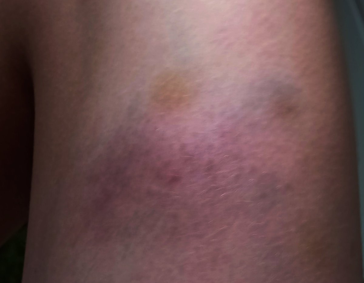 agresteas's tweet photo. punching my leg sesh 🤛❗
I wonder how the bruise will look tmrw??
#shtwt #shedtwt https://t.co/mNCJ8wXHL1