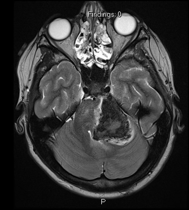 Pediatric Cerebellar Brain Tumor
Check out my new website:
dralanrcohen.com