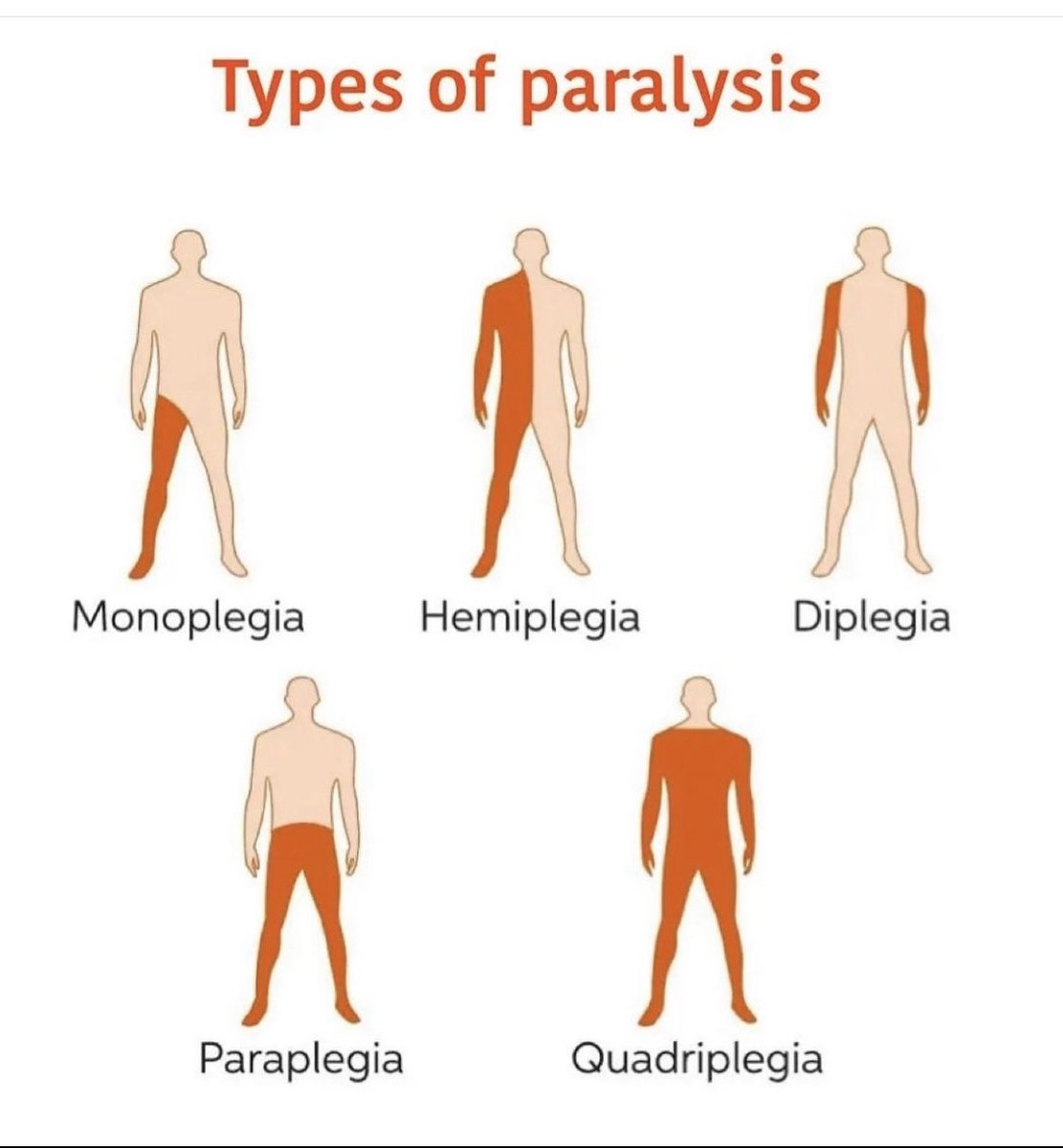 Doctors__squad's tweet photo. Types of Paralysis https://t.co/ItXsSxP7E2