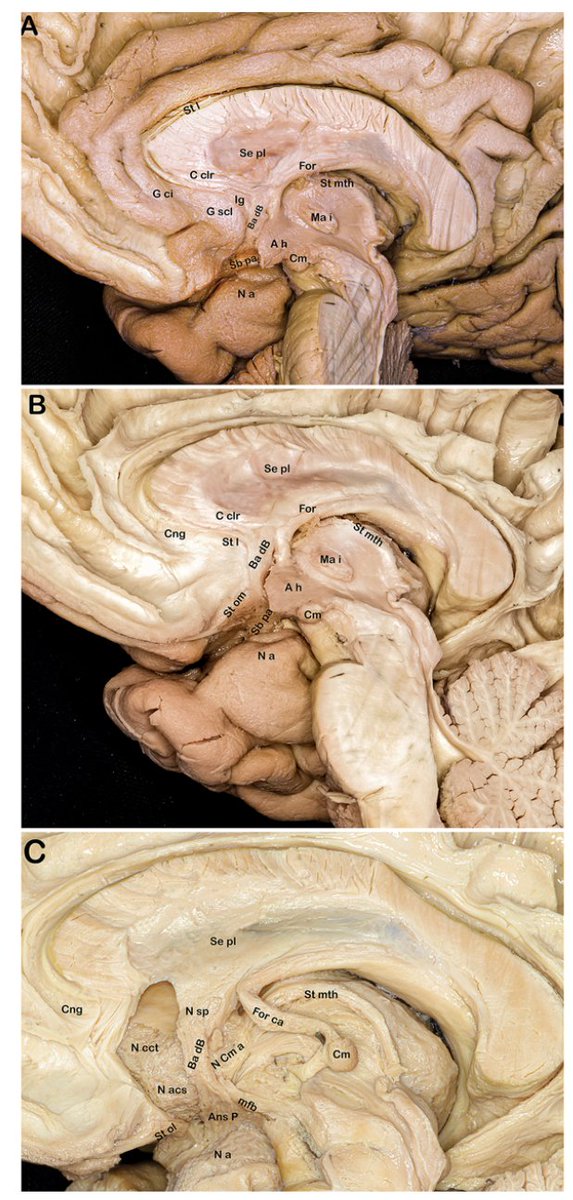 TheJNS's tweet image. #OnlineFirst: Afferent and efferent fiber systems of the human amygdala: anatomical, pathophysiological, and clinical significance.
thejns.org/view/journals/….