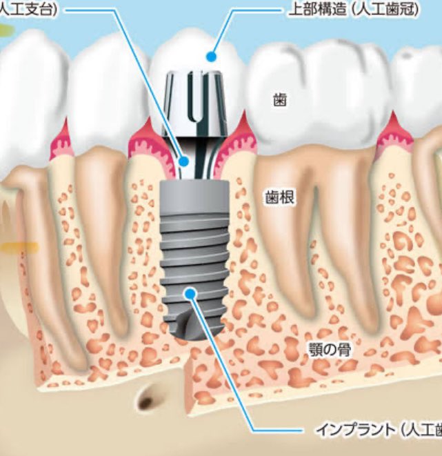 歯科治療の材料には多量のプラスチックが⁈ 治療に使用する材料は歯科医院によって異なるが、多くの場合、プラスチック製品やプラスチック包装された物が使われている。インプラントは性質上、口内の日常的な使用による摩耗や損傷を受けるため、マイクロプラスチックが生成され、体内に摂取されること