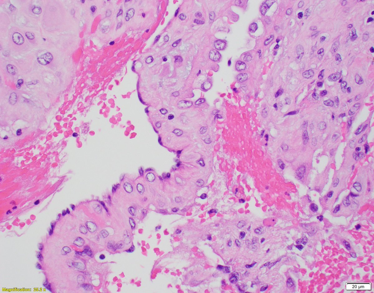 I know I've posted about this relatively recently, but this was too pretty to pass over.
X10 for orientation, x40 for detail
What IHC would be positive in the nuclei?