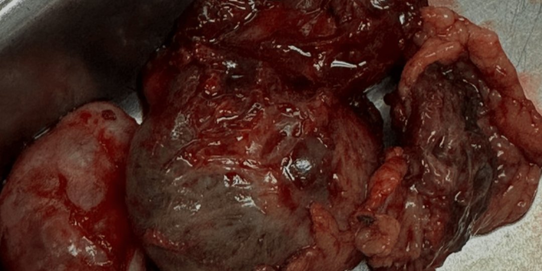 Chronic ectopic pregnancy can hide behind low β‑hCG. 30‑yo with bleeding &amp; adnexal mass—ruptured chronic ectopic found at laparotomy; left salpingo‑oophorectomy done, fertility preserved.
Read more here: hubs.la/Q03vXkFf0

#Cureus  #Gynecology #WomenHealth #ObGyn