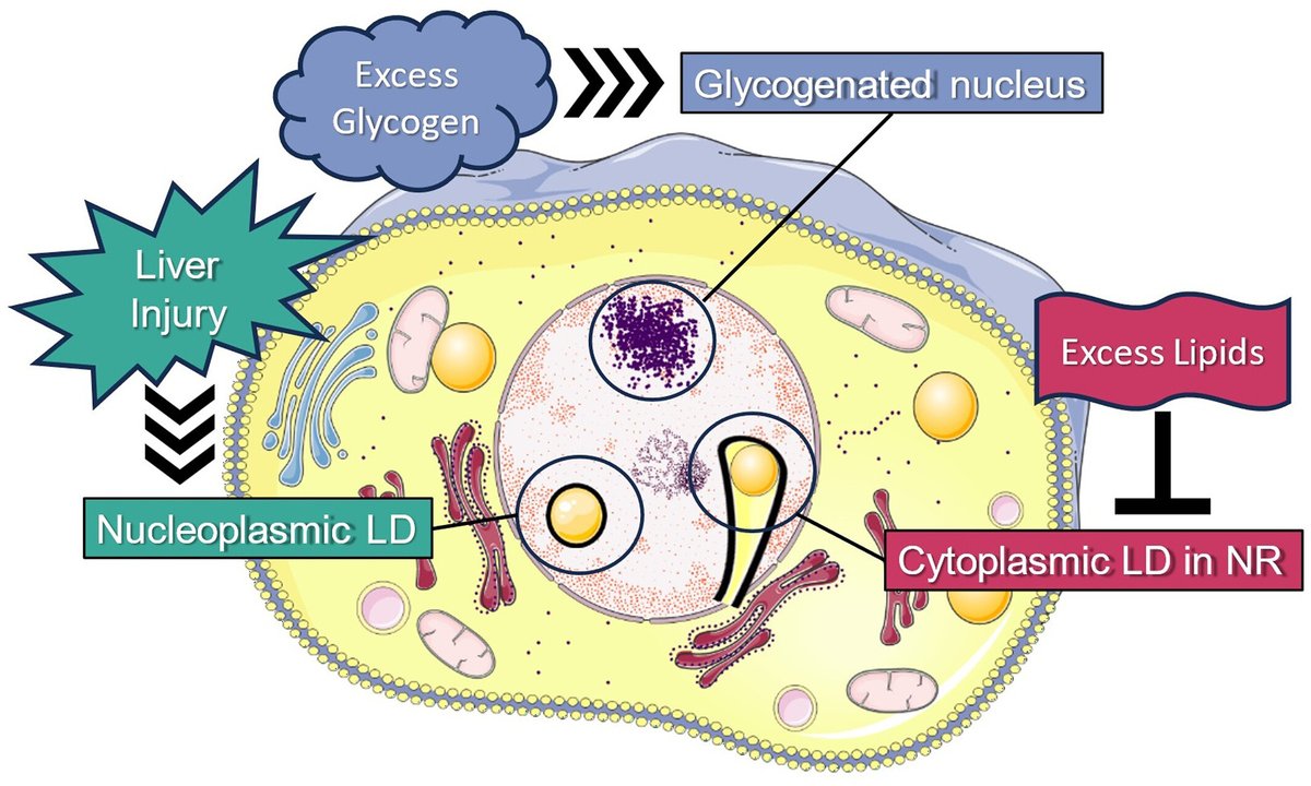 Hepatology Research (@hepatolres) on Twitter photo #LiverPathology
▶️Pathological significance of intranuclear structures in liver biopsy samples
👉doi.org/10.1111/hepr.1…
#LiverX <a href="/WileyHealth/">Wiley Clinical Health</a> #LiverPathology
▶️Pathological significance of intranuclear structures in liver biopsy samples
👉doi.org/10.1111/hepr.1…
#LiverX <a href="/WileyHealth/">Wiley Clinical Health</a>