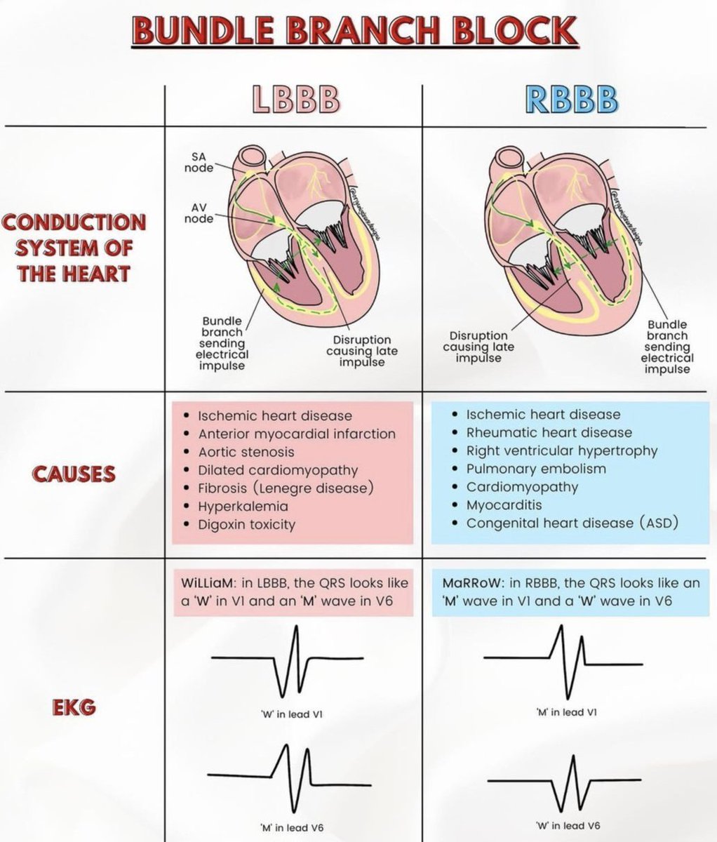 CardiovascularCorner (@trackyourheart) on Twitter photo I've always believed that using the "M" or "W" pattern recognition for diagnosing bundle branch blocks (BBB) should be discouraged. These patterns often don't apply to many cases of either left or right BBB. It's far more effective to teach why a particular BBB appears the way it I've always believed that using the "M" or "W" pattern recognition for diagnosing bundle branch blocks (BBB) should be discouraged. These patterns often don't apply to many cases of either left or right BBB. It's far more effective to teach why a particular BBB appears the way it