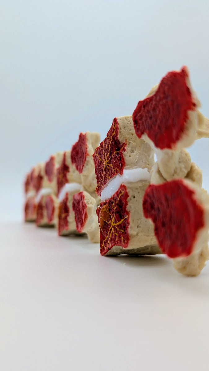 dynamicdisc's tweet image. Midline modelling Modic with the basivertebral nerve.