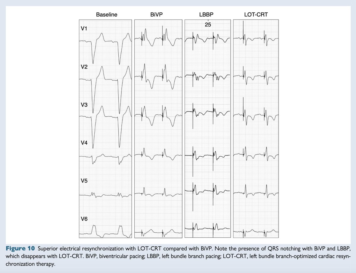 EHRAPresident's tweet image. #EHRAtopicweek ⚡ HOT & LOT-CRT
In some heart failure patients, LV lateral wall delay isn’t just a simple LBBB — it's driven by complex conduction system disease, myocardial scar, or electrical uncoupling.
🧠 Studies show CSP alone can’t always correct this. Even BiV-CRT has…
