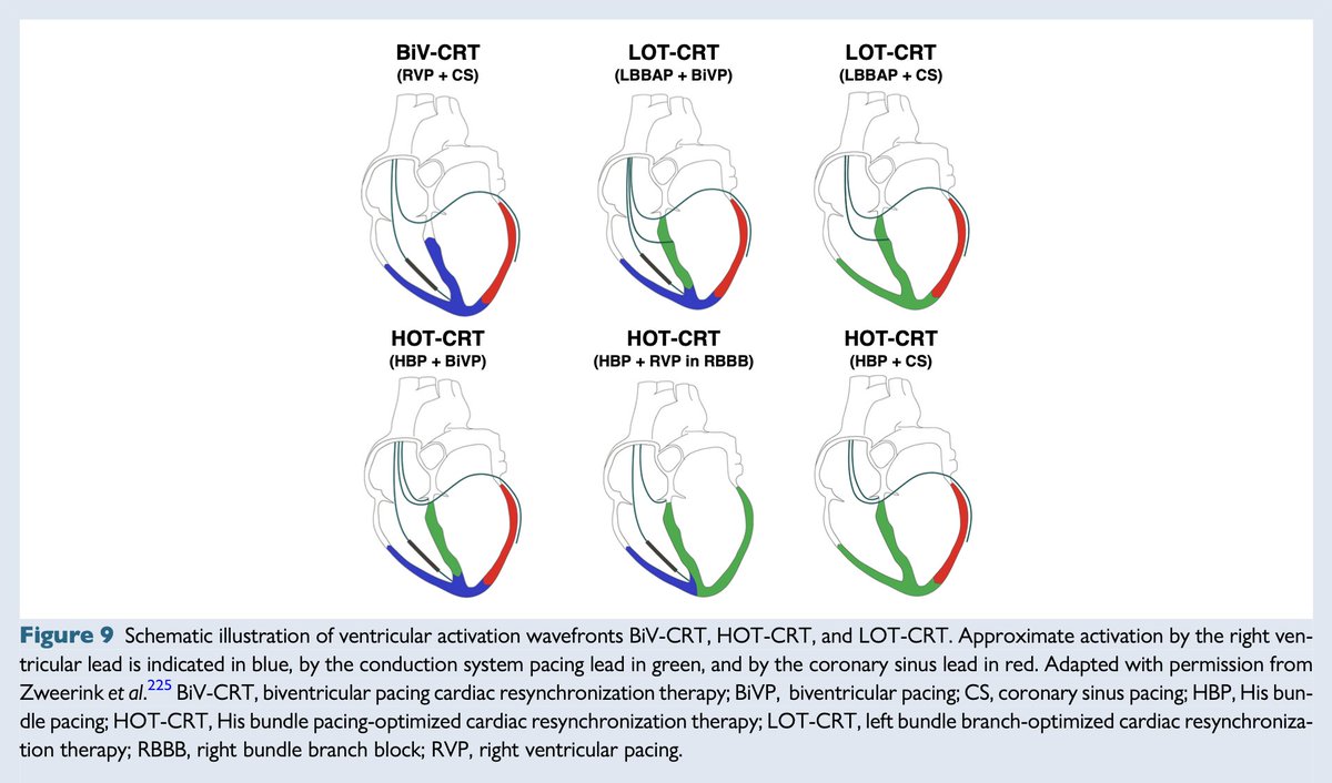 EHRAPresident's tweet image. #EHRAtopicweek ⚡ HOT & LOT-CRT
In some heart failure patients, LV lateral wall delay isn’t just a simple LBBB — it's driven by complex conduction system disease, myocardial scar, or electrical uncoupling.
🧠 Studies show CSP alone can’t always correct this. Even BiV-CRT has…