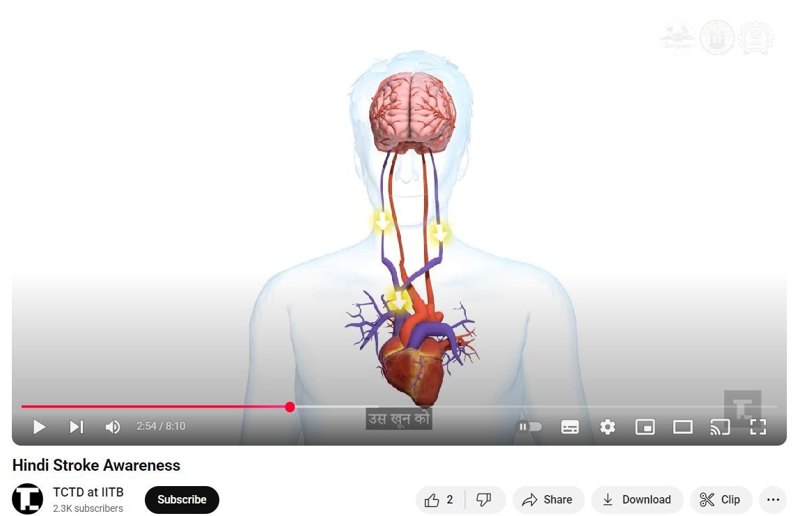Yogesh Kalkonde (@yogesh_kalkonde) on Twitter photo Stroke is a public health priority in India. This simple animation in Hindi on stroke(done with TCTD IIT-B and SHRC, Chhattisgarh) could be a great resource for community health workers. Please help disseminate-lnkd.in/gtnc-4X6 <a href="/strokeindian/">Indian Stroke Association</a> Stroke is a public health priority in India. This simple animation in Hindi on stroke(done with TCTD IIT-B and SHRC, Chhattisgarh) could be a great resource for community health workers. Please help disseminate-lnkd.in/gtnc-4X6 <a href="/strokeindian/">Indian Stroke Association</a>