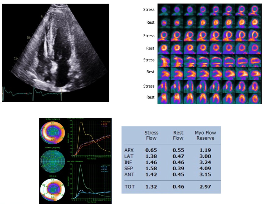 60-year-old male smoker with known apical HCM, ICD (unexplained syncope), non-obstructive CAD on CCTA, psoriatic arthropathy, recurrent chest pain. Cardiac PET/CT performed. What best explains the mechanism underlying these PET findings? Vote below. 

#CVNuc #ThinkPET