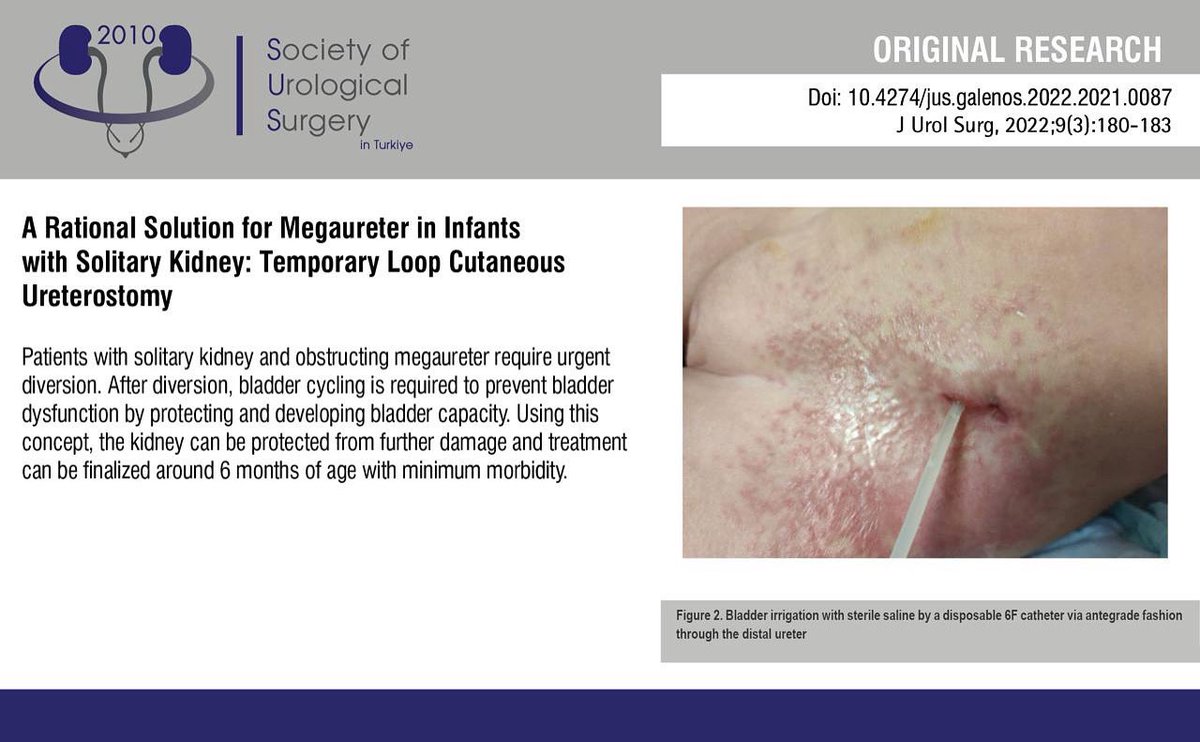 JUsurgery's tweet photo. A Rational Solution for Megaureter in Infants with Solitary Kidney: Temporary Loop Cutaneous Ureterostomy
You can see the free full text of the research by Serdar Tekgül et al.
Link : https://t.co/gDVCowXB0h
#Megaureter #solitary #kidney #bladder #cycling #urinarydiversion https://t.co/fTMqaLd8UC