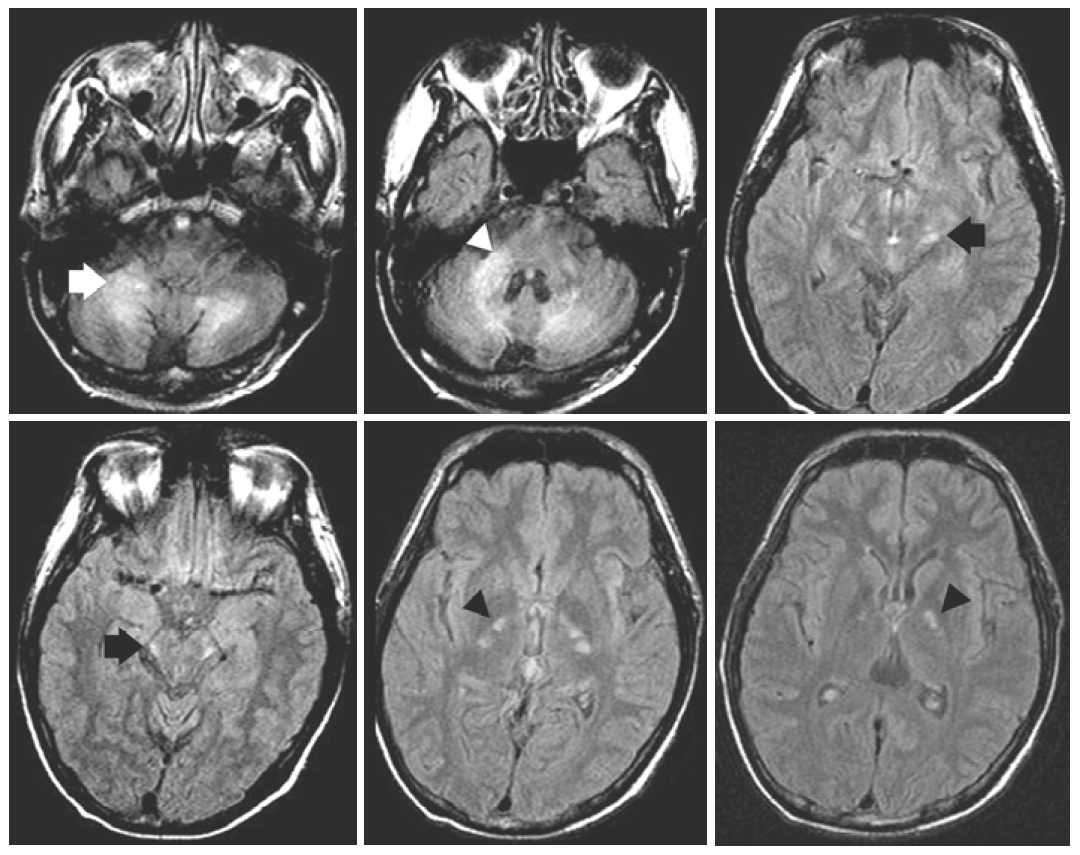 NeuroimagingDB's tweet photo. Adrenoleukodystrophy
✅Auditory pathway病変が特徴的：Radiopaediaの記事がよくまとまっています
https://t.co/jbDsVPJKIy
✅上丘→内側膝状体の経路が中脳背側〜大脳脚の高信号として描出されることがある

画像はPMID: 24868367 https://t.co/fO3I4gqeXI