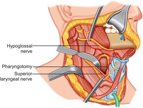 Our case of the month is a rare event occurring after laryngectomy &amp; hemithyroidectomy for a tumour

The patient had a hypoglossal nerve palsy causing swallowing issues post op 
Good operation notes were key to successfully defending this unexplained case

coress.org.uk/case-of-the-mo…