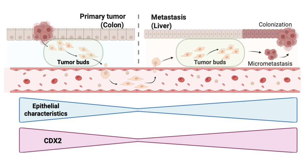 matschan (@matschan1) on Twitter photo Take a look at our latest CDX2 article by our PhD students: Nils Bodmer Rina Mehmeti and Kristin Uth (now all graduated 🌷)!
Big THANKS to all co-authors 🥂.
rdcu.be/eu0Pk
<a href="/snsf_ch/">Swiss National Science Foundation</a> <a href="/igmp_unibern/">Institute of Tissue Medicine and Pathology</a> <a href="/DBMR_UniBe/">BioMedical Research</a>
#gcb #UCI #cancer #tumorbudding Take a look at our latest CDX2 article by our PhD students: Nils Bodmer Rina Mehmeti and Kristin Uth (now all graduated 🌷)!
Big THANKS to all co-authors 🥂.
rdcu.be/eu0Pk
<a href="/snsf_ch/">Swiss National Science Foundation</a> <a href="/igmp_unibern/">Institute of Tissue Medicine and Pathology</a> <a href="/DBMR_UniBe/">BioMedical Research</a>
#gcb #UCI #cancer #tumorbudding