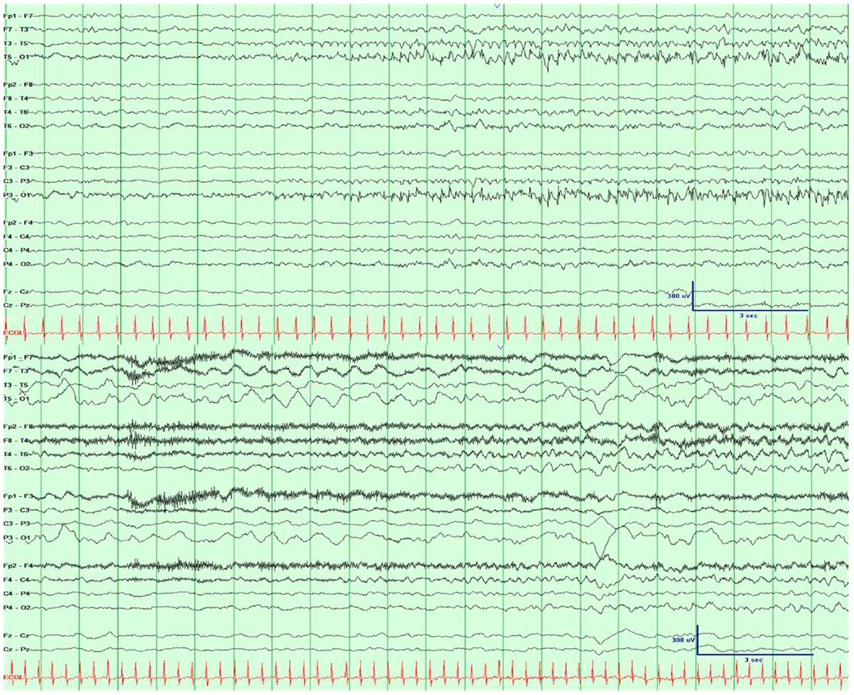 ChildNeuroSoc's tweet image. 📌 New in @AnnalsCNS
Visual Diagnosis: Epilepsy of Infancy With Migrating Focal Seizures in a 3-month-old boy. EEG revealed independent seizure foci in both hemispheres.
🧠 Read more: ow.ly/LxOk50W9n96
