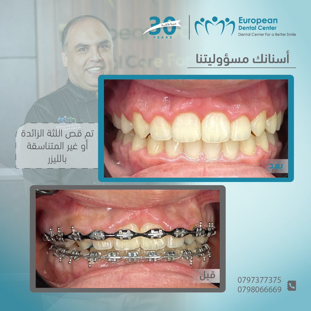 تُعد تقنية قص اللثة بالليزر من الإجراءات الحديثة والمتقدمة في طب الأسنان التجميلي والعلاجي، 
والتي توفر حلاً فعالاً ودقيقًا لمشاكل اللثة الزائدة أو غير المتناسقة.

يستقدم المركز الأوروبي لطب الأسنان أحدث أجهزة الليزر لعلاج وجراحة اللثة وتجميلها

المركز الأوروبي لطب الأسنان 30