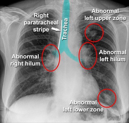 X-RAY QUIZ: Which structure is visibly normal in this patient with lung cancer?
A: Left upper zone
B: Left hilum
C: Left lower zone
D: Right paratracheal stripe
E: Right hilum
Answer  slide 2. Start Quiz buff.ly/3WsdAz4