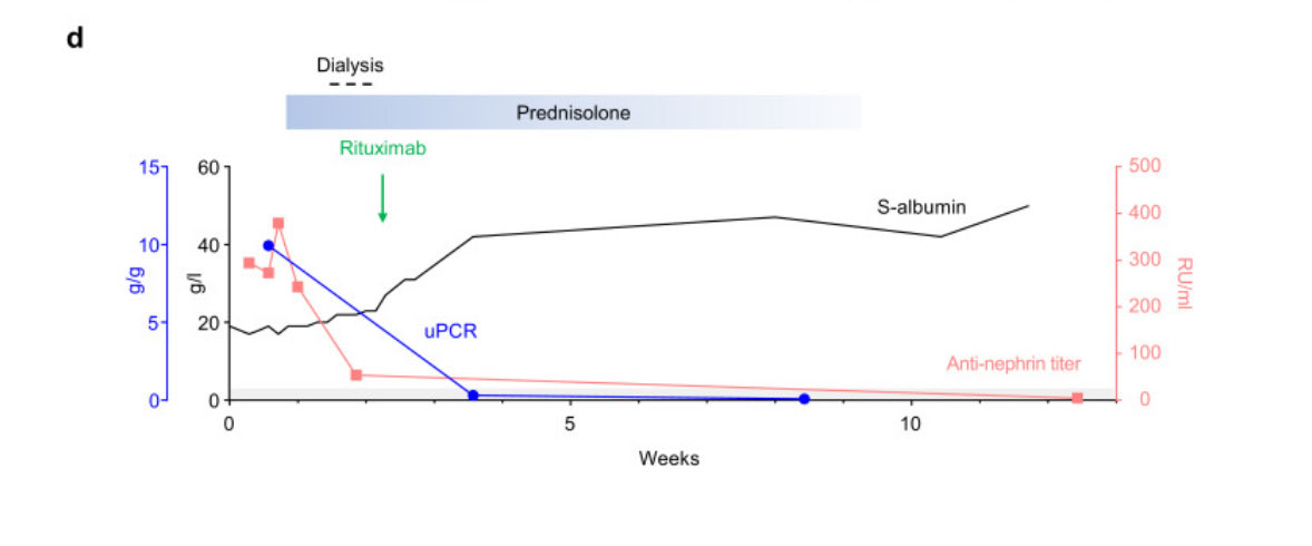 Non-invasive Diagnosis of Antinephrin–Associated Podocytopathy

▫️3 cases

▫️Detected by immunoprecipitation/ELISA

▫️Their high specificity for podocytopathies in combination with a strong correlation with disease activity hold the potential for a non-invasive diagnosis