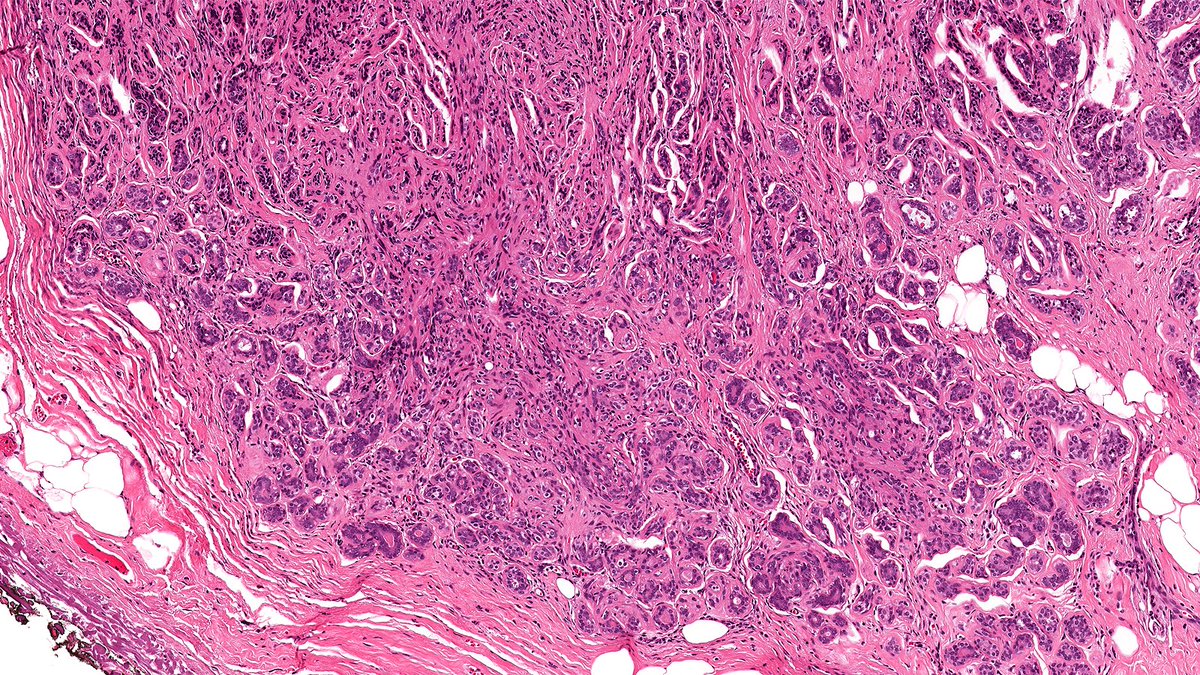 Let’s review various adenoses of breast this week!

Case of Sclerosing Adenosis of Breast 🔬

Sclerosing adenosis shows increase in number of glands (‘adensosis’) distorted by perilobular stromal sclerosis and fibrosis.

#PathX #PathTwitter #breastpath