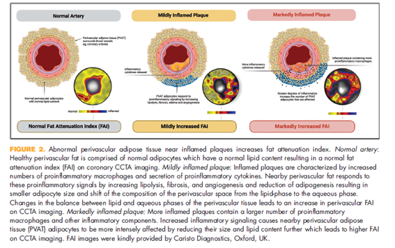 🗣️Orticumab: the potential to harness oxidized LDL to reduce coronary inflammation with plaque-targeted therapy

▶️El tratamiento con orticumab representa una forma nueva y específica de reducir la inflamación arterial

journals.lww.com/co-lipidology/…
<a href="/LipidoSeen/">LipidoSEEN</a>