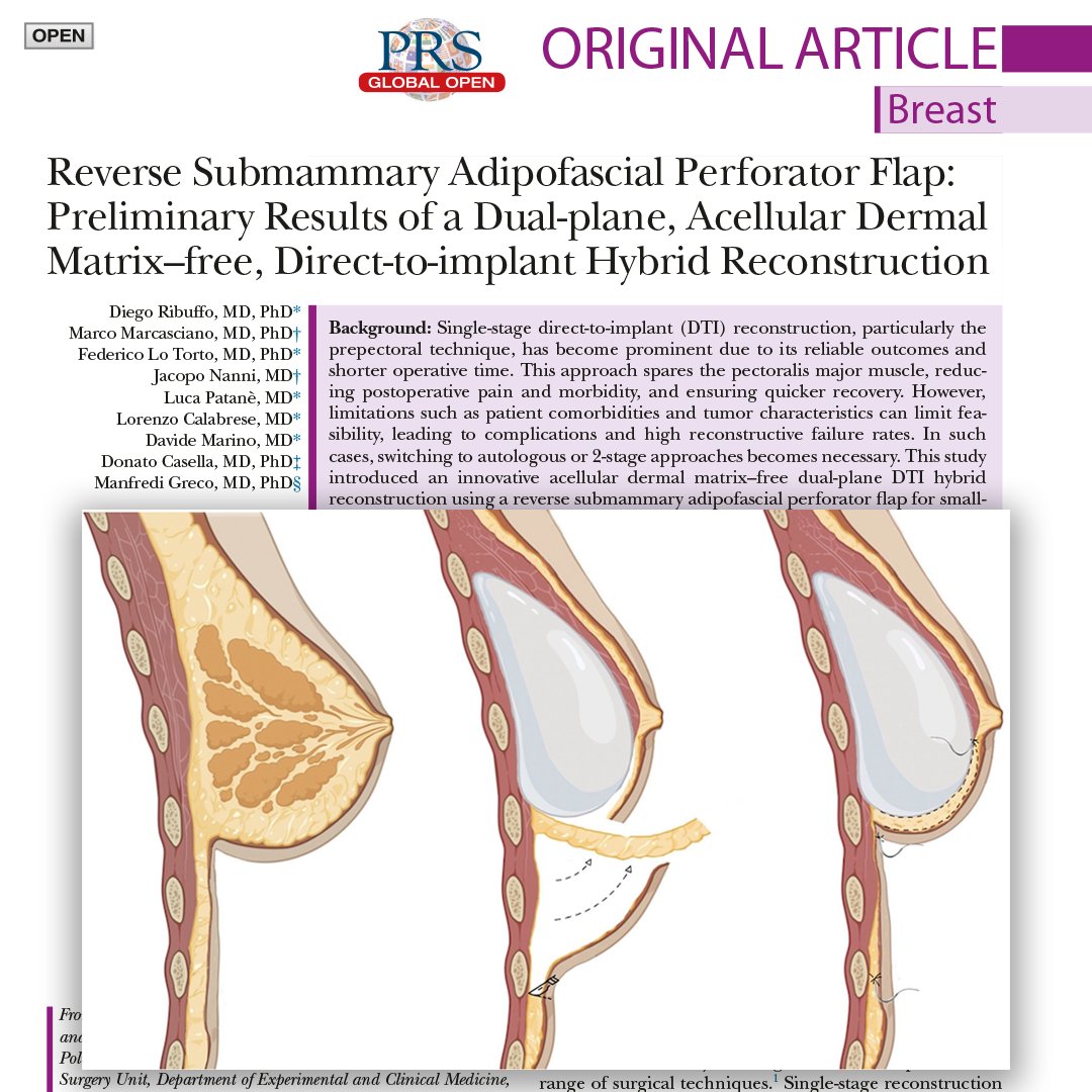 PRSGlobalOpen's tweet image. Discover a novel, acellular dermal matrix–free direct-to-implant hybrid technique designed for small-volume breasts — combining safety, aesthetics, and patient satisfaction in one-stage reconstruction.
👉 Read the full article for FREE now: l8r.it/F0bE